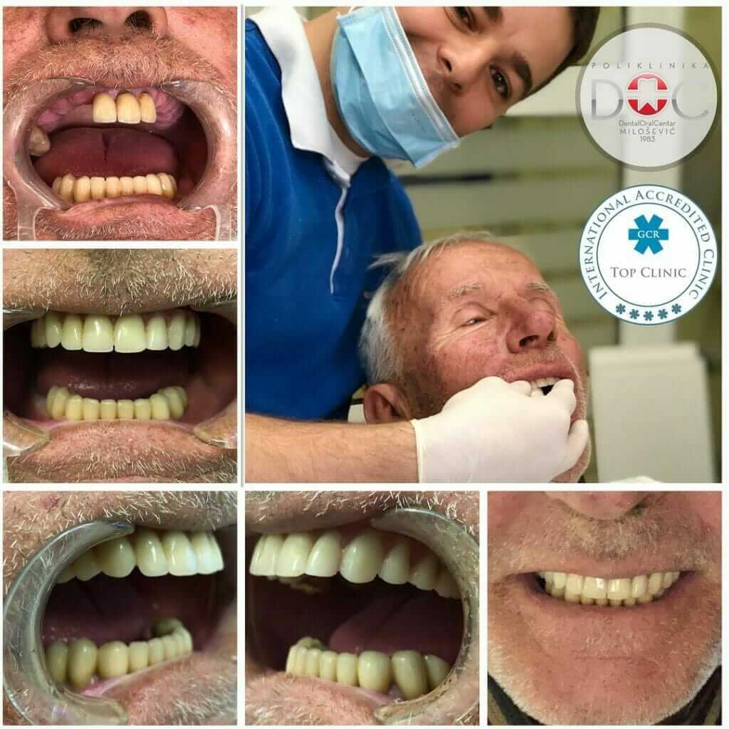 29352057_1656770361069861_2819585014546711979_o-1024×1024 pacijent pre i posle ugradnje zubnim implanata