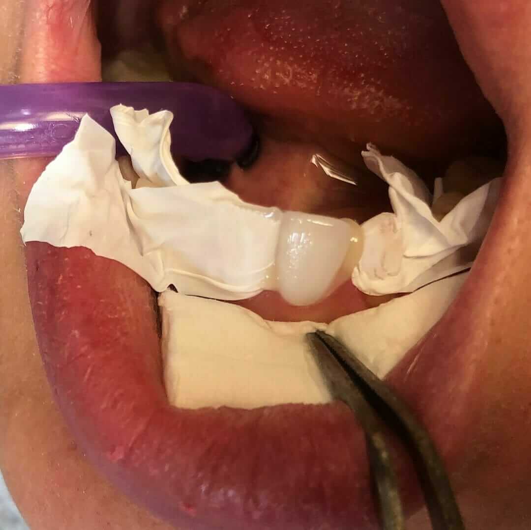 32767684_1709924645754432_5621770392671617024_o proces postavljanja keramickih faseta Dental Oral Centar Beograd