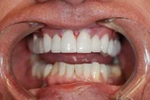 pacijent nakon postavljanja implantata
