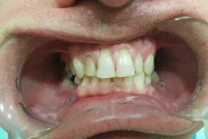 pacijent pe postavljanja implantata