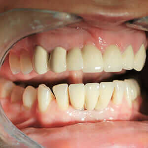 cirkonijum-krunice-na-obe-vilice-1 cirkonijum krunice na obe vilice Dental Oral Centar Beograd
