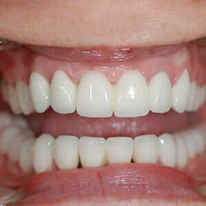 cirkonijum-krunice-na-obe-vilice-4 cirkonijum krunice na obe vilice Dental Oral Centar Beograd