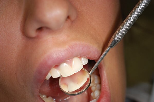 cirkonijum-krunice-nyprd3cx1nn7tn3sbburl2xi6ouoaf8zdbaraurwyo ugrađene cirkonijum krunice Dental Oral Centar Beograd