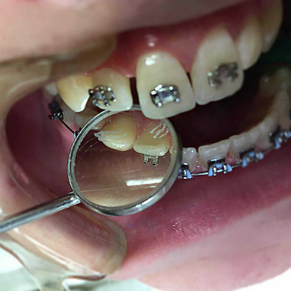 ortodoncija proteze sa metalnim bravicama